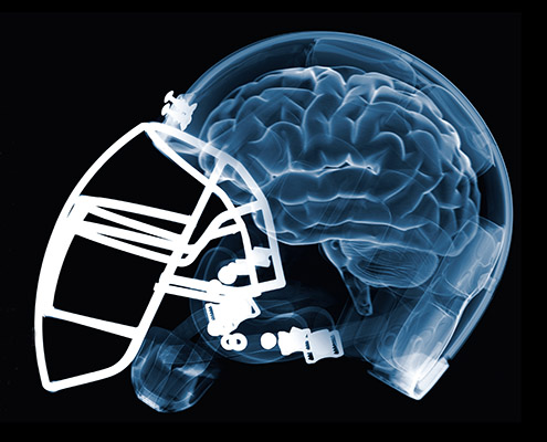 Concussions further linked to lasting sleep and fatigue issues